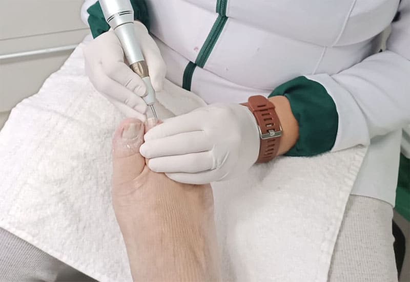 5 Sinais de que você precisa de um Podólogo