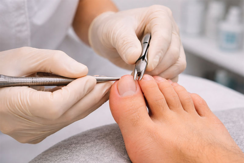Podologia em Guarulhos: Tratamentos para Unha Encravada e Calos