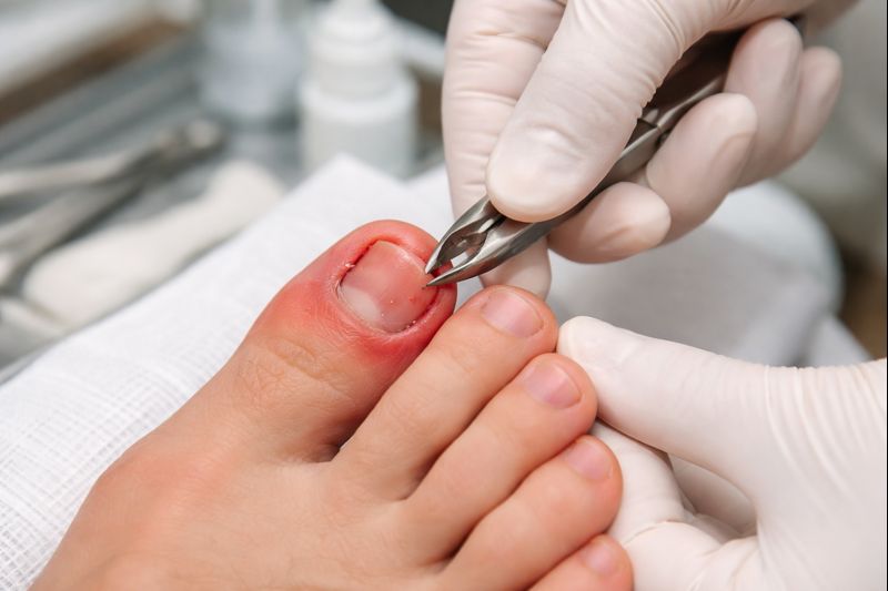 unha encravada com cuidado podológico