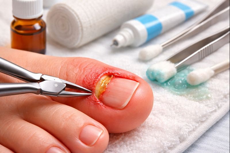 unha encravada inflamada em tratamento